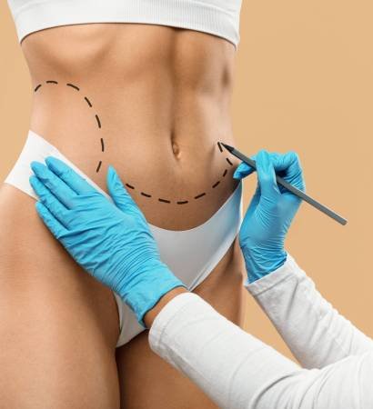 Doctor Drawing Dashed Line Marks On Female Body Before Plastic Surgery Operation, Unrecognizable Young Woman In Underwear Getting Ready For Aesthetic Liposculpting Treatment, Creative Collage
